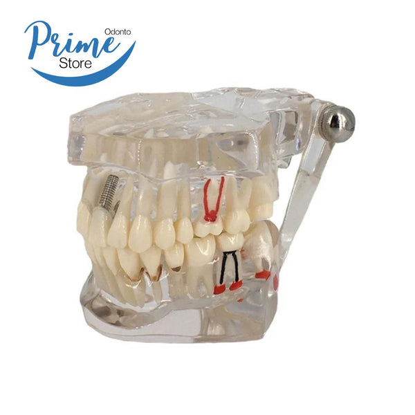 Modelo transparente de dentes para doenças, implante dentário e prótese dentária