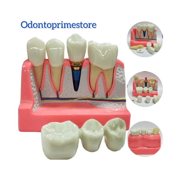 Macro Modelo Prótese/Implante/Lentes Dentais com dentes destacáveis